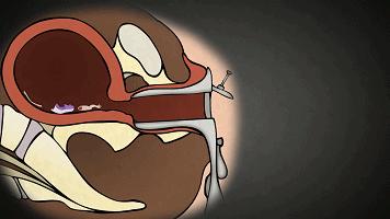 女子避孕失败,每年多少人避孕失败