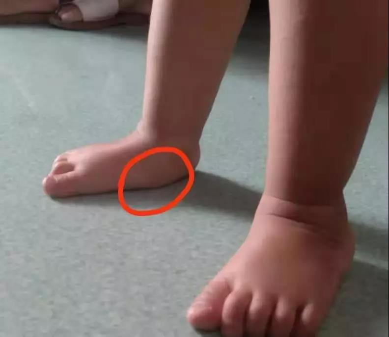 儿童扁平足的最佳治疗方法,全国治疗扁平足前十的医院