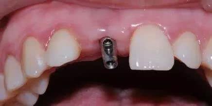 下颌缺失四颗牙修复案例,智齿移植修复缺失牙