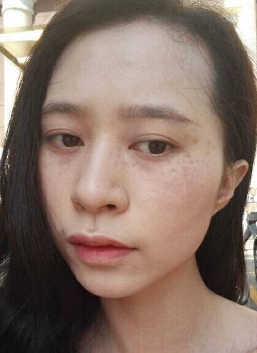 祛斑过程中不可以吃什么,激光祛斑和中药提取祛斑哪个好