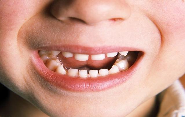 宝宝换牙牙齿稀疏牙缝大,小孩乳牙换的牙齿长得很丑怎么办