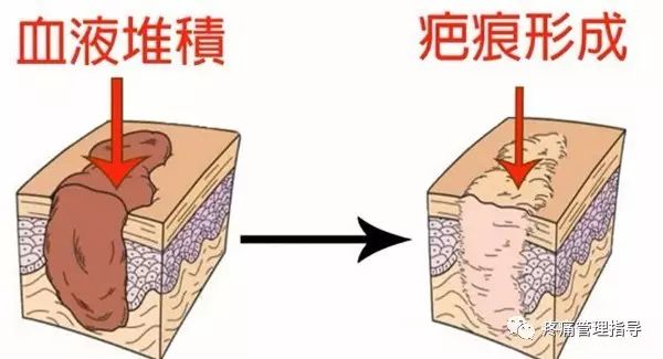 肩周炎的原因与锻炼方法