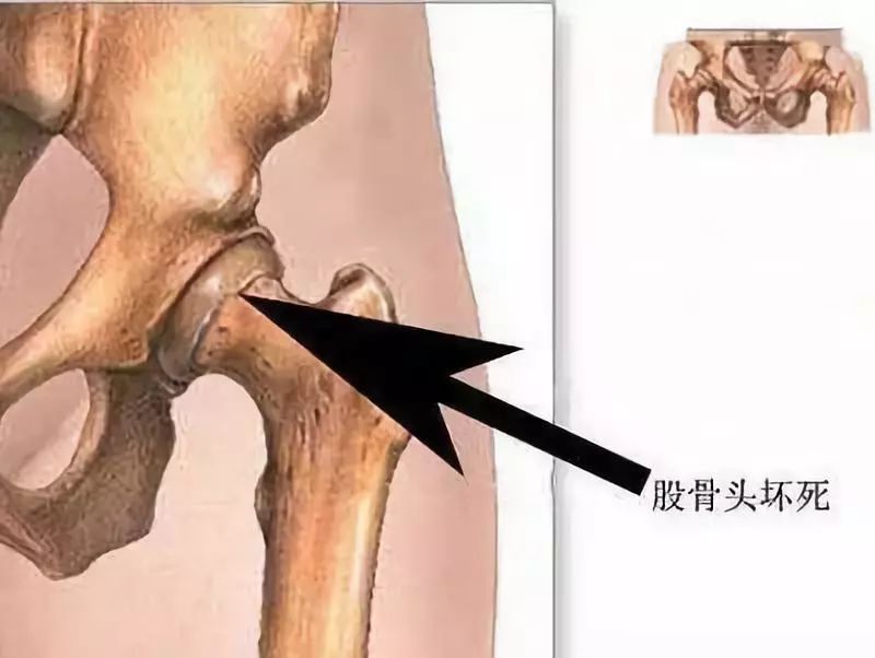 髋关节疼有哪几种原因,髋关节痛如何能确诊什么原因引起