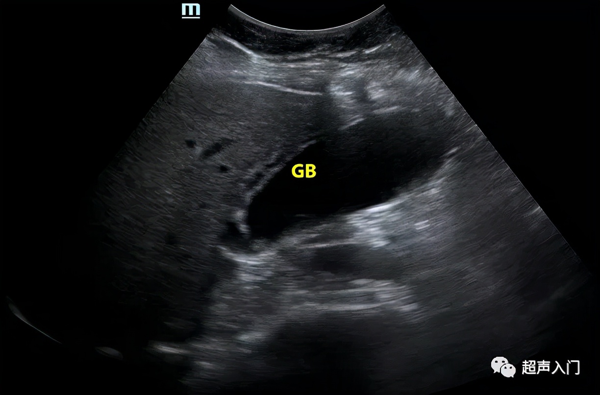 急性胆囊炎超声表现入门教学视频,急性胆囊炎超声诊断怎么写