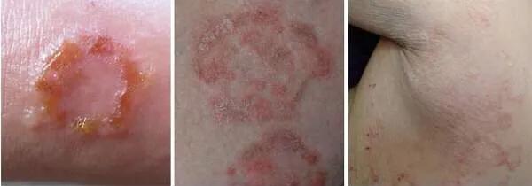 痒痒病怎么治,痒痒用什么中草药止痒最好