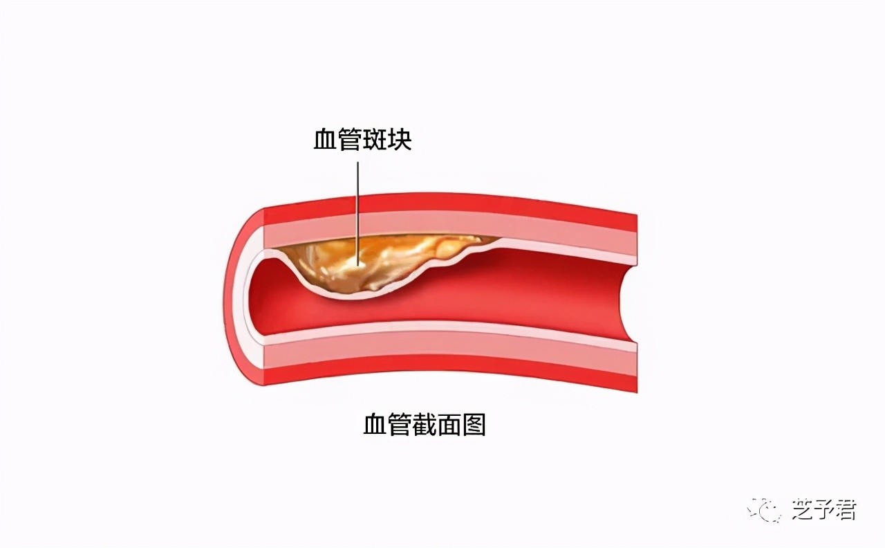 醋泡大蒜的功效对高血压有帮助吗,大蒜治高血压的做法