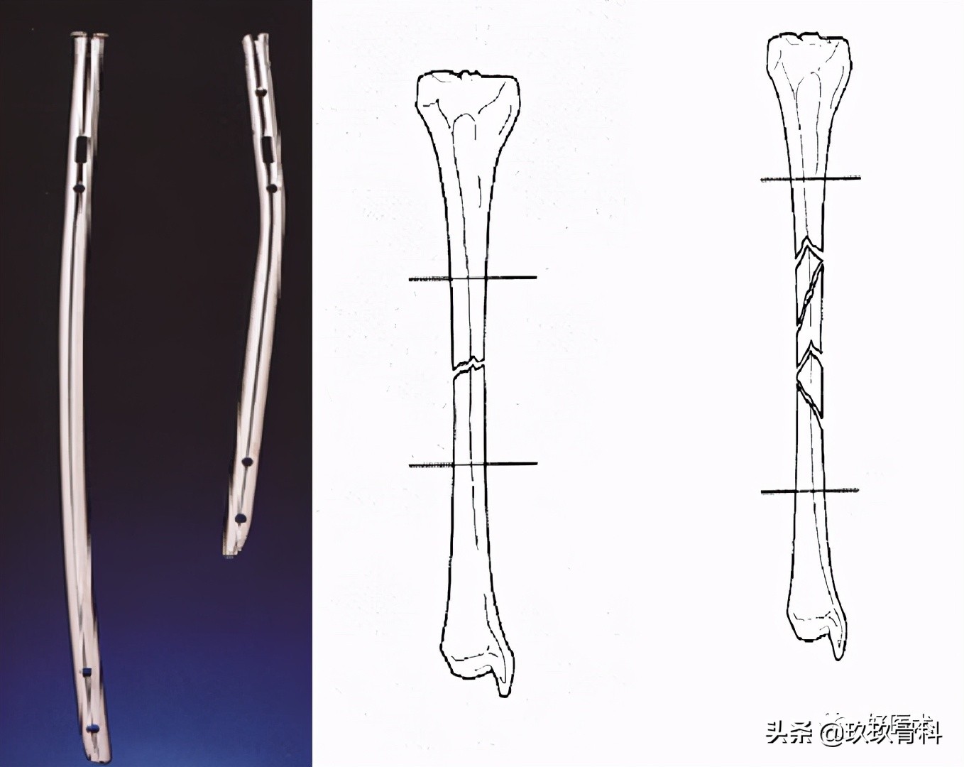髓内钉技巧,髓内钉教学视频讲解