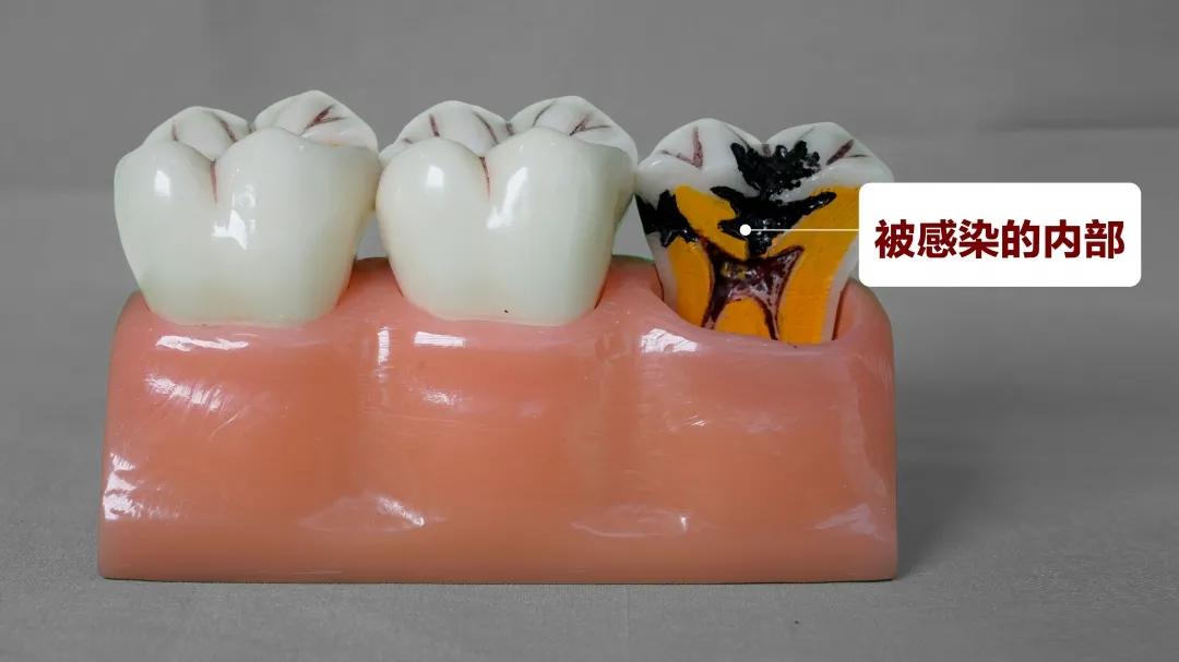 根管治疗是不是就是杀死神经,根管第一次封药是杀神经吗