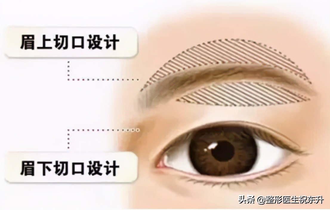 想做提眉手术哪家美容院好,想做提眉手术