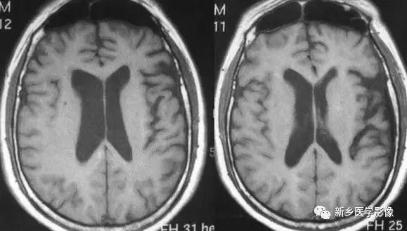 影像学脑室扩大,脑室显大怎么理解