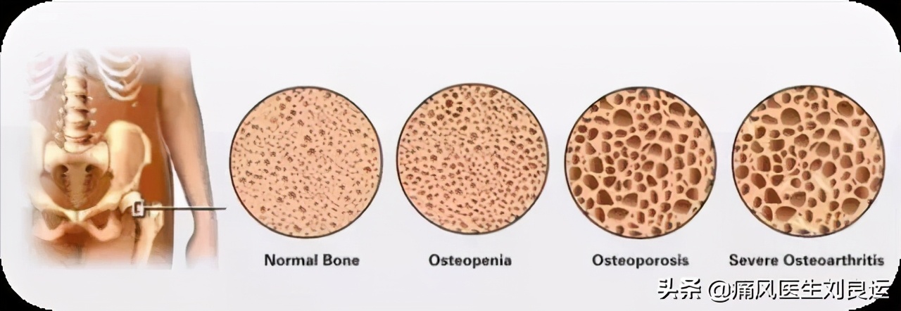 痛风血钙高,尿酸高引起的痛风骨头啥样的