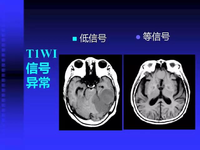 头颅mri读片视频教程,颅脑mri读片入门教程视频讲解全集