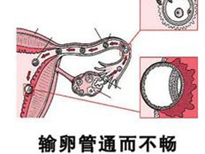 输卵管通了还是怀不上,输卵管通而不畅能怀上吗
