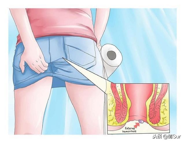 排便不顺、便血、便秘、肛门肿痛?妊娠期痔疮如何预防和缓解?