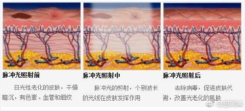 科普|光子嫩肤全攻略,做了光子后禁忌事项有哪些?