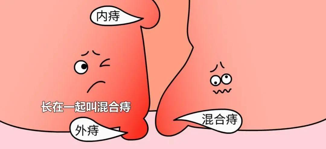 【李解肛肠】第34期｜老年人肛门有肿物脱出可能是这两种疾病在作祟