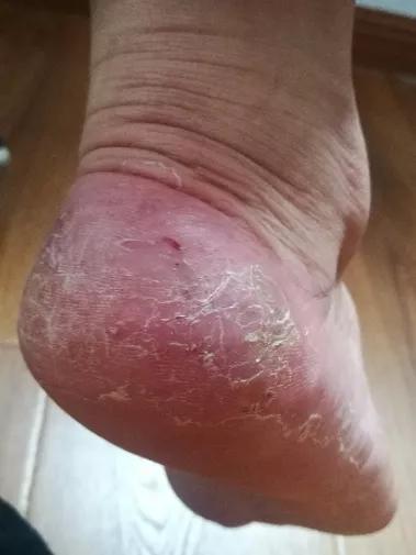 如何去除真菌部位的硬角质,角质去除小妙招