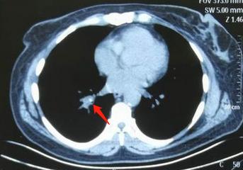 26岁确诊肺癌,26岁得了肺结核