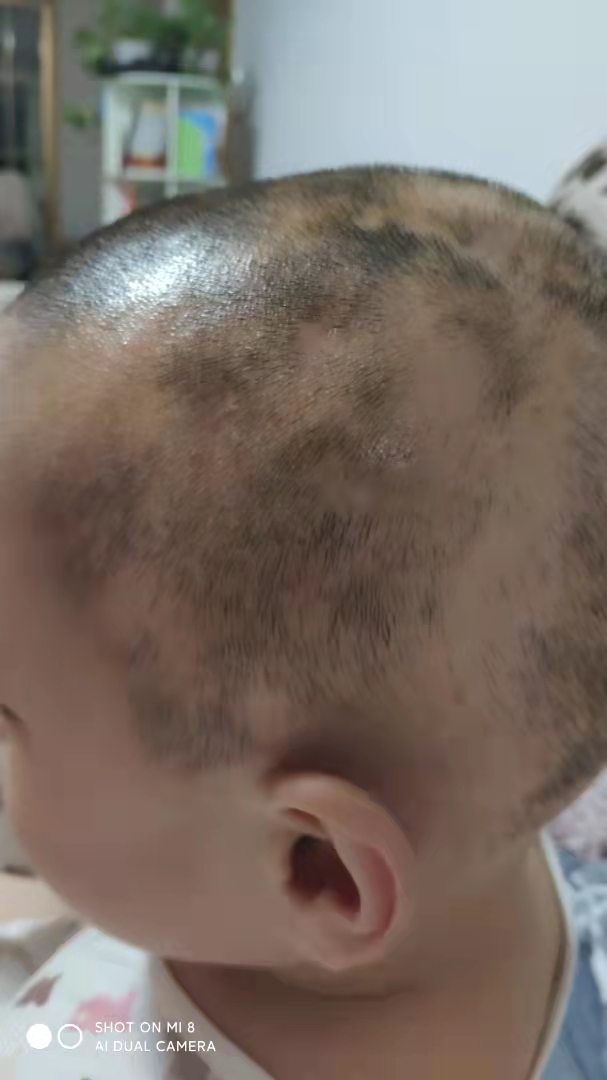 斑秃属于疑难杂症么,斑秃治疗中越来越严重怎么回事