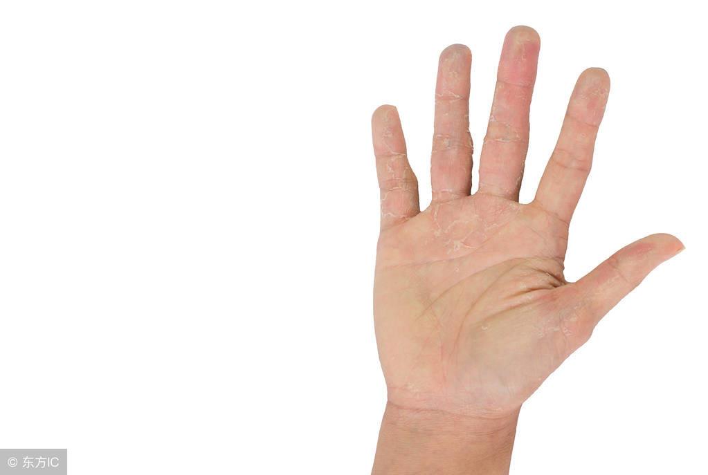 手部皮肤脱皮的原因,什么疾病会导致手脱皮