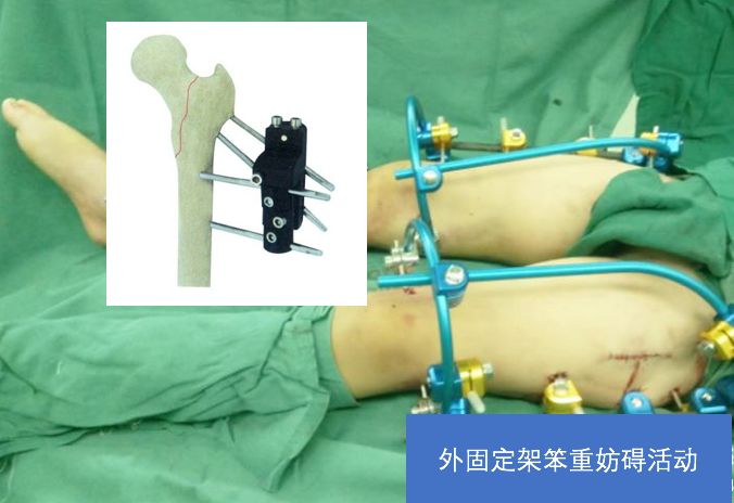 髋部骨折对老年人来说意味着什么,老人髋部骨折多长时间恢复到正常