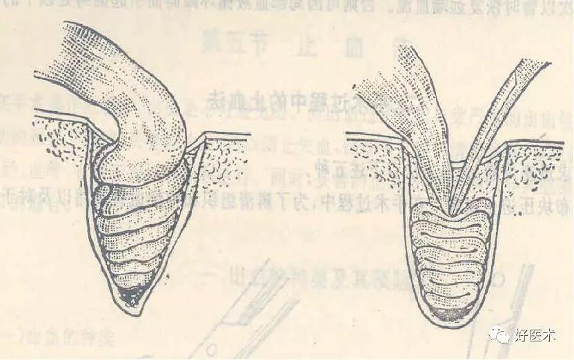 结扎止血时用哪种缝合方法,外科血管止血结扎的基本操作