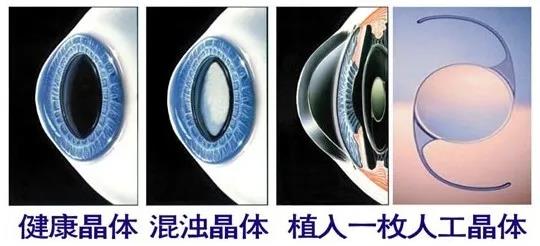 高岩院长做客健康时间——手术治疗白内障的最佳时期是什么时候？