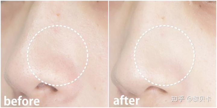 公认最好用的去黑头神器,网红推荐去黑头神器