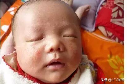 儿科常见出疹性疾病,儿科常见出疹性疾病有哪些