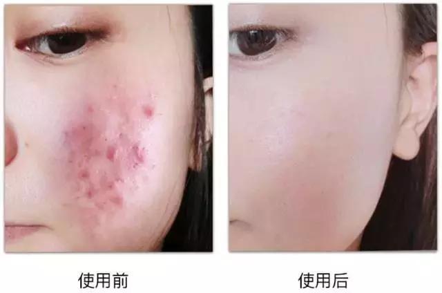 熬夜追《知否》后脸上狂暴痘？这些德国产品可以拯救你的脸！