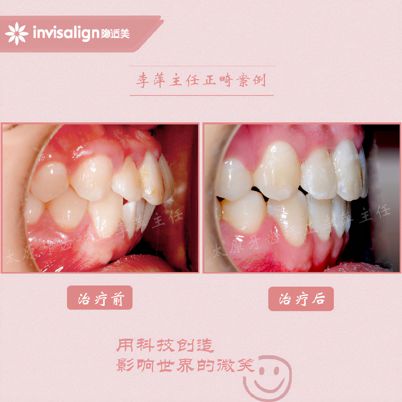 太原牙齿矫正拔牙拔六颗有危害吗,太原牙齿开合矫正