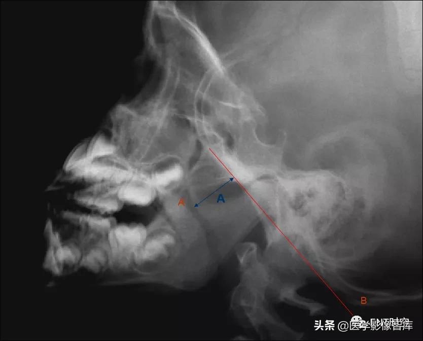 腺样体肥大有必要做x射线复查吗,最简单检测腺样体肥大的方法