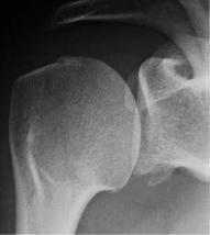 肩关节评定量表cms,肩关节功能评估法cms