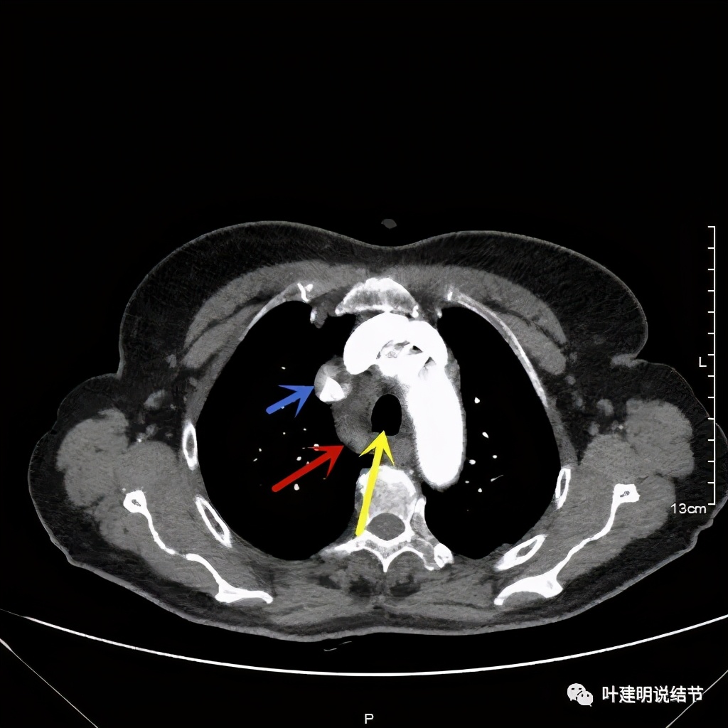 胸部高分辨ct检查注意事项,胸部ct扫描有没有危害