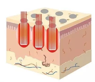 点阵激光后皮肤为何越恢复越黑,点阵激光多久能退红恢复正常皮肤