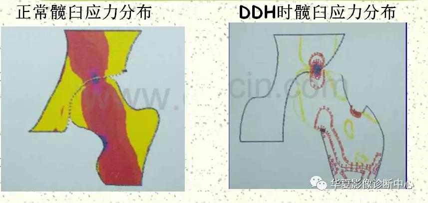 先天性髋关节脱位,先天性髋关节脱位属不属于残疾人
