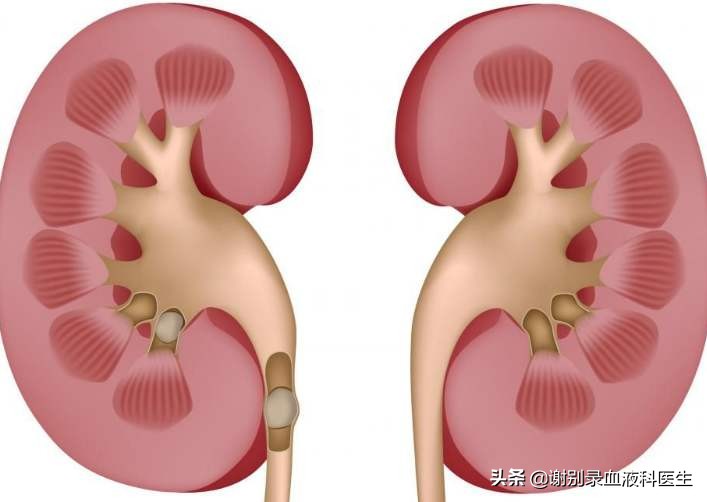 紫癜肾炎拖久了会很严重吗,紫癜严重了是什么后果