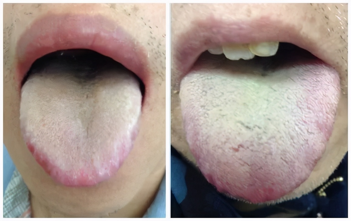 夏天全身无力犯困是不是有湿气,经常犯困是湿气太重吗怎么调理