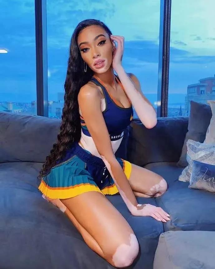 库兹马女朋友有白癜风会全白吗,库兹马与白癜风超模女友海边度假