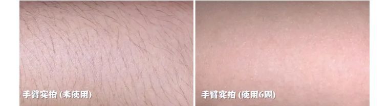 j-style脱毛仪测评,j-style美容仪好用吗