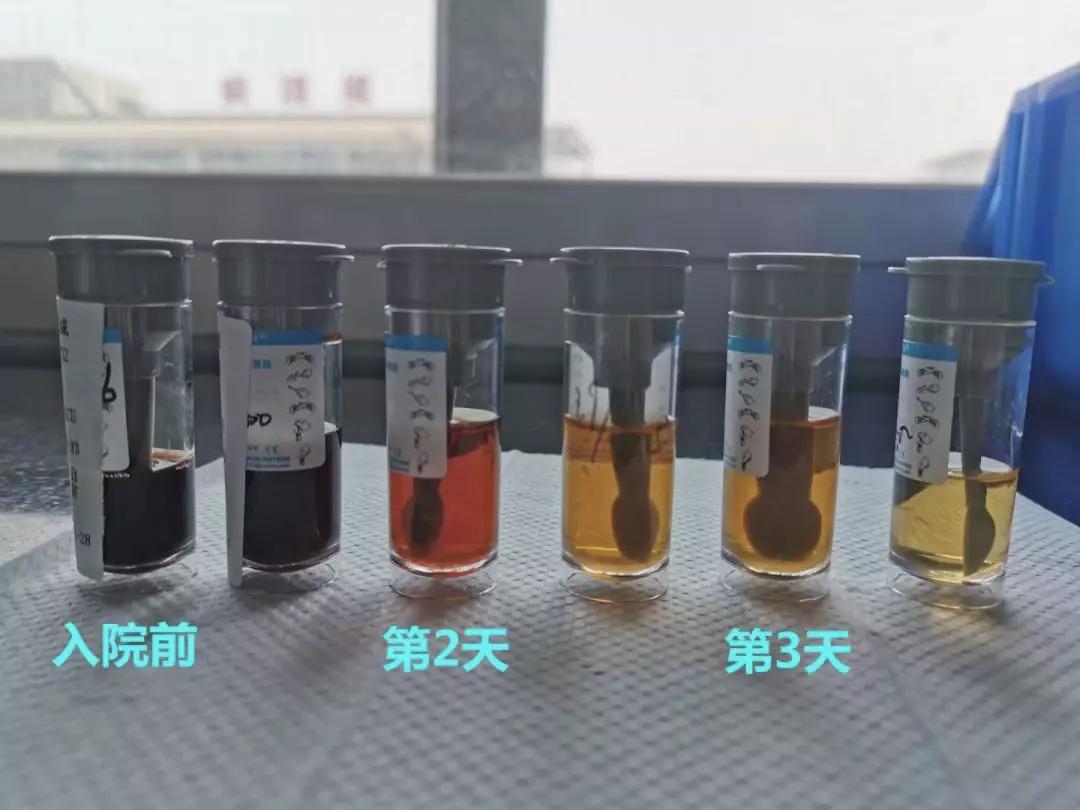 3岁小孩晨起尿呈酱油色怎么回事,3岁男童出现酱油尿