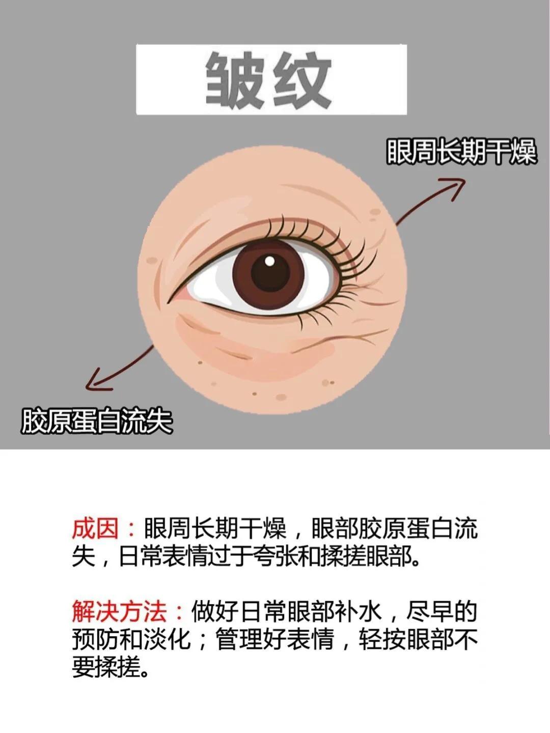 黑眼圈眼袋脂肪粒怎么去除,黑眼圈有纹有脂肪粒用什么