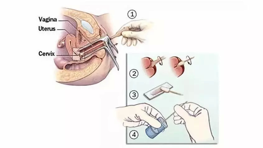 女性tct检查能查出疱疹病毒感染吗,女性tct和hpv只检查一个选哪个