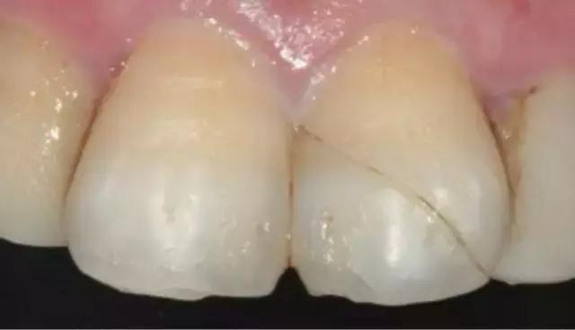 前牙磕掉一个小尖怎么修复,换过的牙磕掉了一小块怎么修复