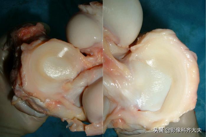 膝关节半月板损伤的磁共振,膝关节半月板病变的mri诊断与鉴别