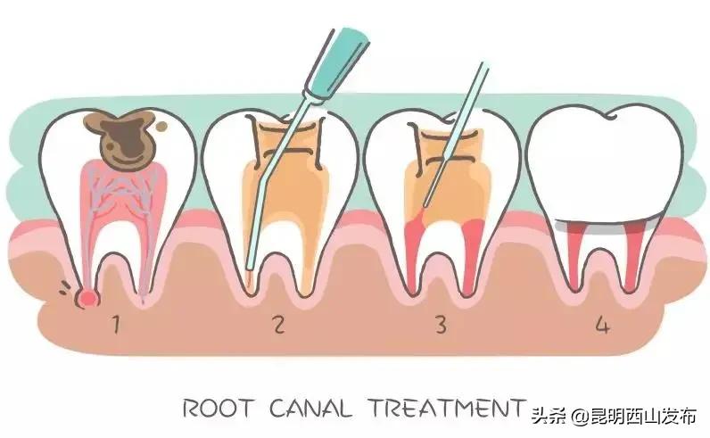 牙齿上有黑点可怕吗,牙齿上有小黑点原来这么可怕