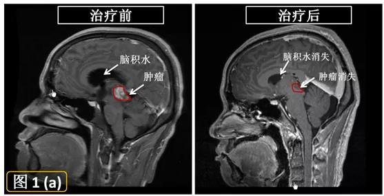 伽玛刀治疗疾病的优点,伽玛刀治疗什么病