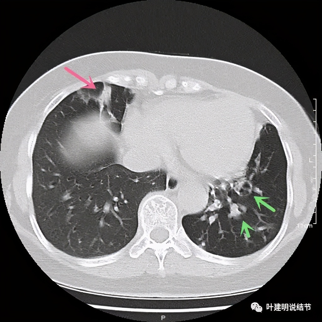 这样的实性结节伴小空洞会是肺癌吗？