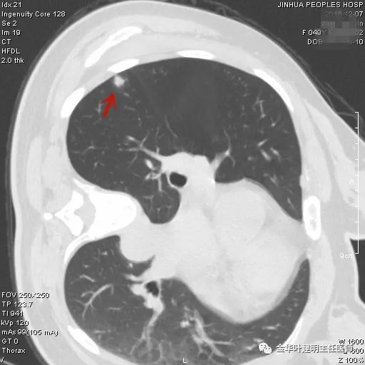 叶建明谈实性结节,叶建明肺实性良性结节会变癌症吗