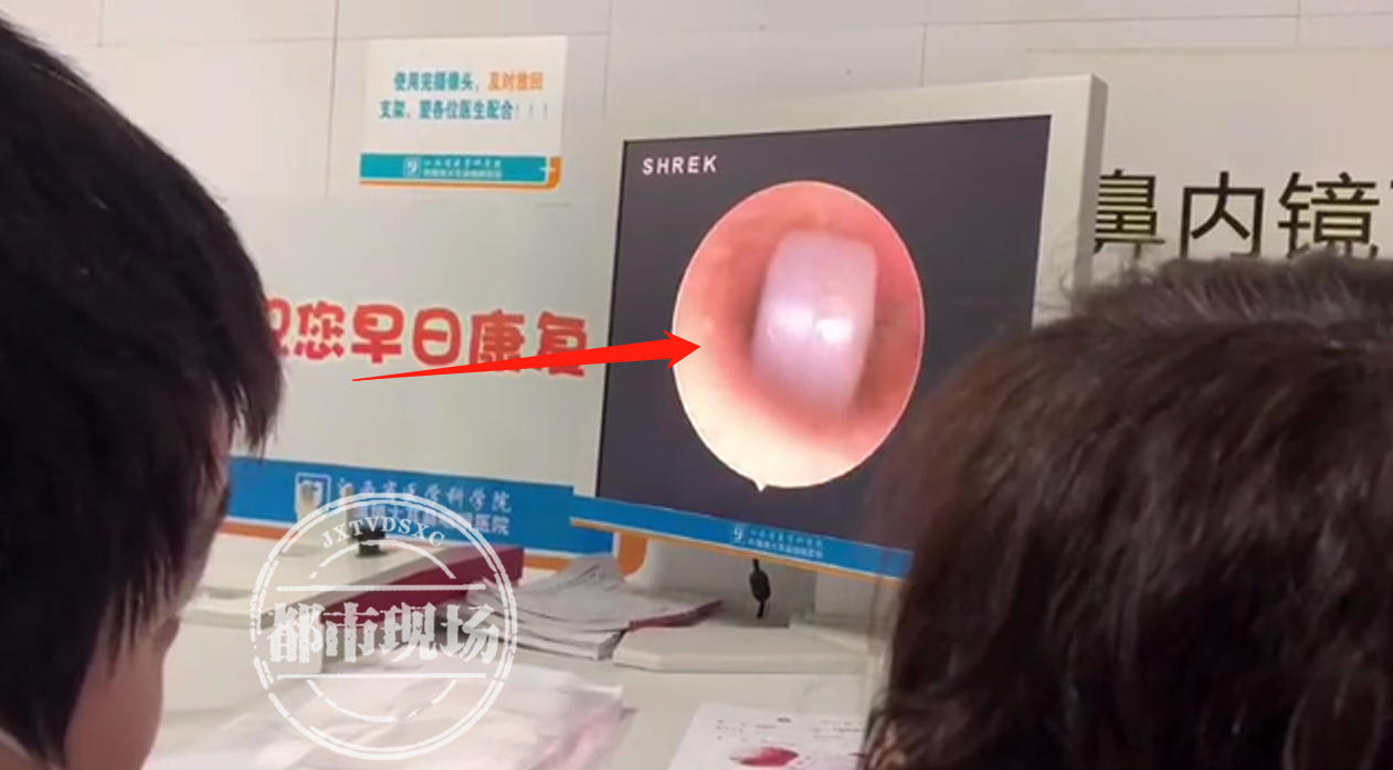 儿童耳朵进异物做手术,儿童耳内塞异物后果